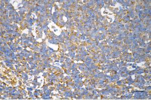 Immunohistochemistry was performed on paraffin-embedded human lymphoma using NFKB1 antibody (ABIN7799638), 1:200).