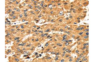 The image on the left is immunohistochemistry of paraffin-embedded Human liver cancer tissue using ABIN7131050(SH3KBP1 Antibody) at dilution 1/45, on the right is treated with fusion protein. (SH3KBP1 antibody)