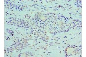 Immunohistochemistry of paraffin-embedded human breast cancer using ABIN7168694 at dilution of 1:100 (SLURP1 antibody  (AA 1-103))