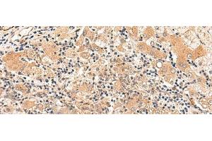 Immunohistochemistry of paraffin-embedded Human liver cancer tissue using HPCA Polyclonal Antibody at dilution of 1:30(x200)