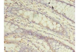 Immunohistochemistry of paraffin-embedded human colon cancer using ABIN7172361 at dilution of 1:100 (TRAPPC3 antibody  (AA 1-180))