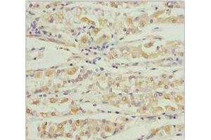 Immunohistochemistry of paraffin-embedded human gastric cancer using ABIN7164013 at dilution of 1:100 (KCNS3 antibody  (AA 1-180))