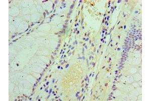 Immunohistochemistry of paraffin-embedded human colon cancer using ABIN7156671 at dilution of 1:100 (IFIT3 antibody  (AA 1-490))