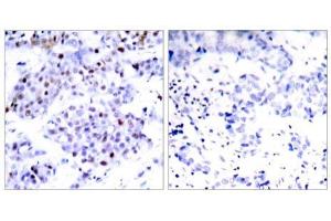 Immunohistochemical analysis of paraffin-embedded human breast carcinoma tissue using STAT6 (Ab-645) antibody (E021051). (STAT6 antibody)