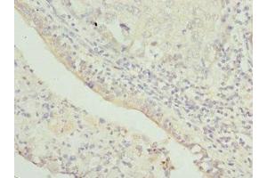 Immunohistochemistry of paraffin-embedded human lung cancer using ABIN7172352 at dilution of 1:100 (TRAPPC1 antibody  (AA 1-260))