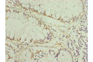 Immunohistochemistry of paraffin-embedded human colon cancer using ABIN7151254 at dilution of 1:100 (TRIM31 antibody  (AA 186-425))