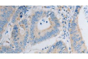 Immunohistochemistry of paraffin-embedded Human colon cancer using PDX1 Polyclonal Antibody at dilution of 1:30 (PDX1 antibody)