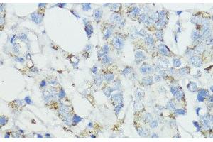 Immunohistochemistry of paraffin-embedded Human mammary cancer using SOD3 Polyclonal Antibody at dilution of 1:100 (40x lens). (SOD3 antibody)