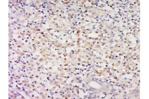 Paraformaldehyde-fixed, paraffin embedded human cervical carcinoma tissue, Antigen retrieval by boiling in sodium citrate buffer(pH6) for 15min, Block endogenous peroxidase by 3% hydrogen peroxide for 30 minutes, Blocking buffer (normal goat serum) at 37°C for 20min, Antibody incubation with Rabbit Anti-CCDC58 Polyclonal Antibody, Unconjugated  at 1:500 overnight at 4°C, followed by a conjugated secondary and DAB staining (CCDC58 antibody  (AA 71-144))