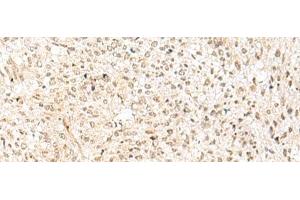 Immunohistochemistry of paraffin-embedded Human liver cancer tissue using RBX1 Polyclonal Antibody at dilution of 1:50(x200) (RBX1 antibody)
