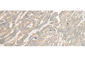 Immunohistochemistry of paraffin-embedded Human liver cancer tissue using RSU1 Polyclonal Antibody at dilution of 1:30(x200) (RSU1 antibody)