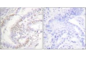 Immunohistochemistry analysis of paraffin-embedded human lung carcinoma, using FANCD2 (Phospho-Ser222) Antibody. (FANCD2 antibody  (pSer222))