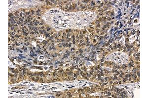 c-Myb Mouse Monoclonal Antibody at 1/100 staining human lung cancer and adjacent non-tumor tissue by IHC-P.