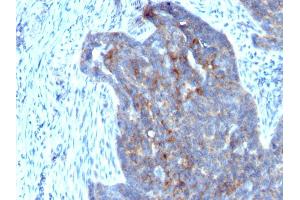 Formalin-fixed, paraffin-embedded human Ovarian Carcinoma stained with RBP1 (RBP/872) (RBP1 antibody)