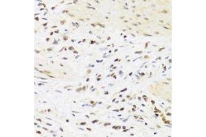 Immunohistochemistry of paraffin-embedded human breast cancer using SUMO4 Antibody. (SUMO4 antibody)