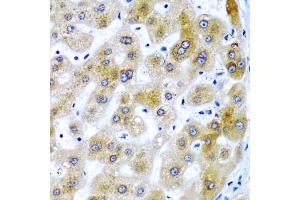 Immunohistochemistry of paraffin-embedded human liver damage using SECISBP2 antibody (ABIN6128699, ABIN6147497, ABIN6147498 and ABIN6222461) at dilution of 1:200 (40x lens).