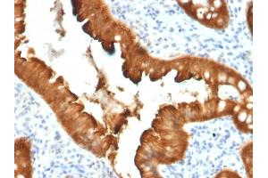 Formalin-fixed, paraffin-embedded human Colon Carcinoma stained with Villin Mouse Monoclonal Antibody (VIL1/2376). (Villin 1 antibody  (AA 179-311))