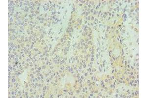 Immunohistochemistry of paraffin-embedded human breast cancer using ABIN7155529 at dilution of 1:100 (SUV39H2 antibody  (AA 201-410))