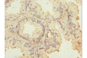Immunohistochemistry of paraffin-embedded human prostate cancer using ABIN7143006 at dilution of 1:100 (FIBP antibody  (AA 1-364))