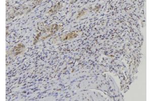 ABIN6272660 at 1/100 staining Human lung cancer tissue by IHC-P. (BPIFA1 antibody  (Internal Region))