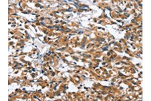 The image on the left is immunohistochemistry of paraffin-embedded Human thyroid cancer tissue using ABIN7128679(BPI Antibody) at dilution 1/50, on the right is treated with fusion protein.