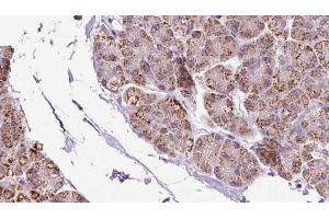 ABIN6273236 at 1/100 staining Human pancreas cancer tissue by IHC-P.