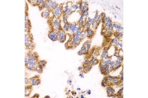 Immunohistochemistry of paraffin-embedded human liver cancer using GLUD2 antibody at dilution of 1:100 (x40 lens).