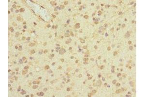 Immunohistochemistry of paraffin-embedded human glioma using ABIN7163444 at dilution of 1:100 (PIEZO1 antibody  (AA 2230-2420))