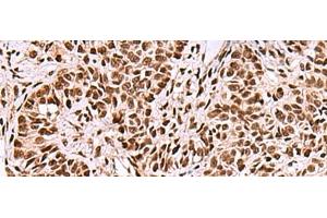 Immunohistochemistry of paraffin-embedded Human ovarian cancer tissue using FOXK2 Polyclonal Antibody at dilution of 1:50(x200)