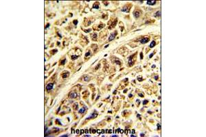 Formalin-fixed and paraffin-embedded human hepatocarcinoma with PRELP Antibody , which was peroxidase-conjugated to the secondary antibody, followed by DAB staining. (PRELP antibody  (C-Term))