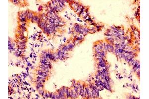IHC image of ABIN7156043 diluted at 1:500 and staining in paraffin-embedded human colon cancer performed on a Leica BondTM system. (FcRn antibody  (AA 24-297))