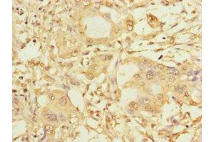 Immunohistochemistry of paraffin-embedded human pancreatic cancer using ABIN7146024 at dilution of 1:100 (SPAG9 antibody  (N-Term))