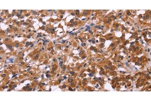 Immunohistochemistry of paraffin-embedded Human thyroid cancer tissue using SPATA7 Polyclonal Antibody at dilution 1:30 (SPATA7 antibody)