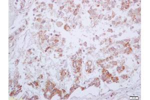 Formalin-fixed and paraffin embedded human liver carcinoma labeled with Anti-Phospho-PKM2 (Tyr105) Polyclonal Antibody, Unconjugated (ABIN744773) at 1:200 followed by conjugation to the secondary antibody and DAB staining (PKM2 antibody  (pTyr105))