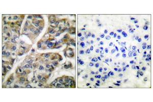 Immunohistochemical analysis of paraffin-embedded human breast carcinoma tissue using Granzyme B antibody (ABIN2843546). (GZMB antibody  (N-Term))