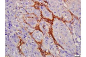 Formalin-fixed and paraffin embedded human laryngocarcinoma labeled with Anti-EGFRvIII Polyclonal Antibody, Unconjugated  at 1:200 followed by conjugation to the secondary antibody and DAB staining (EGFRviii antibody  (AA 1-50))