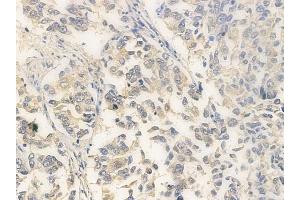 ABIN6260726 and ABIN6266946 at 1/100 staining human lung squamous cell carcinoma by IHC-P.