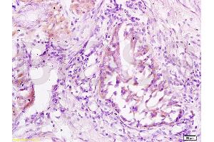 Formalin-fixed and paraffin embedded: human lung carcinoma labeled with Anti-JNK1/3 Polyclonal Antibody (ABIN669381), Unconjugated at 1:200 followed by conjugation to the secondary antibody and DAB staining (JNK antibody  (AA 201-300))