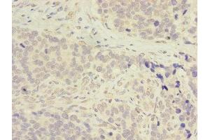 Immunohistochemistry of paraffin-embedded human gastric cancer using ABIN7143283 at dilution of 1:100 (ADA antibody  (AA 157-343))