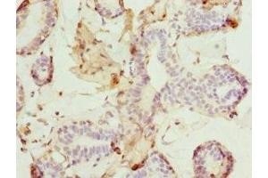 Immunohistochemistry of paraffin-embedded human breast cancer using ABIN7165308 at dilution of 1:100 (DR1 antibody  (AA 1-176))
