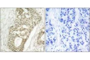 Immunohistochemistry analysis of paraffin-embedded human breast carcinoma, using PKC delta (Phospho-Ser645) Antibody. (PKC delta antibody  (pSer645))