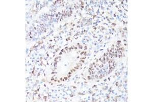 Immunohistochemistry of paraffin-embedded human appendix using P-MYC-S62 antibody (ABIN3019544, ABIN3019545, ABIN3019546 and ABIN6225456) at dilution of 1:100 (40x lens).