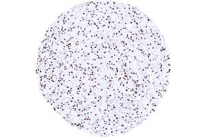 Clear cell renal cell carcinoma with strong Histone H3 staining of tumor cells (Histone 3 antibody)