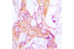 Immunohistochemical analysis of PDLIM1 staining in human lung cancer formalin fixed paraffin embedded tissue section. (PDLIM1 antibody  (Center))