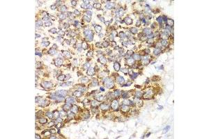 Immunohistochemistry of paraffin-embedded human esophageal cancer using TFAM antibody. (TFAM antibody  (AA 1-220))