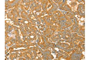 The image on the left is immunohistochemistry of paraffin-embedded Human thyroid cancer tissue using ABIN7130772(PTPN22 Antibody) at dilution 1/30, on the right is treated with fusion protein. (PTPN22 antibody)
