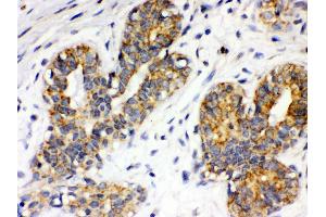 Anti- Integrin alpha 4 Picoband antibody, IHC(P) IHC(P): Human Mammary Cancer Tissue (ITGA4 antibody  (C-Term))