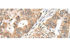 Immunohistochemistry of paraffin-embedded Human gastric cancer tissue using BLNK Polyclonal Antibody at dilution of 1:40(x200) (B-Cell Linker antibody)