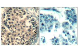 Immunohistochemical analysis of paraffin-embedded human breast carcinoma tissue using HDAC4/HDAC5/HDAC9(Phospho-Ser246/259/220) Antibody(left) or the same antibody preincubated with blocking peptide(right). (HDAC4/HDAC5/HDAC9 antibody  (pSer220, pSer246, pSer259))