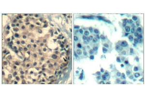 Immunohistochemical analysis of paraffin-embedded human breast carcinoma tissue using HDAC4/HDAC5/HDAC9(Phospho-Ser246/259/220) Antibody(left) or the same antibody preincubated with blocking peptide(right).